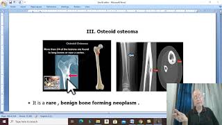 Orthopaedic in Arabic 56  Osteoid osteoma  by DrWahdan [upl. by Childers]