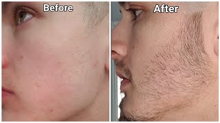 Minoxidil Beard Growth  3 Month Transformation  BEFORE and AFTER [upl. by Georges688]