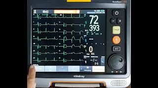 6 MONITOR DESFIBRILADOR 12 ECG [upl. by Rubin]