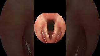 Time Lapse of Vocal Cord Nodule Formation and Resolution [upl. by Lemaceon406]