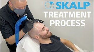 Skalp® Scalp Micropigmentation Treatment Process [upl. by Kelila]