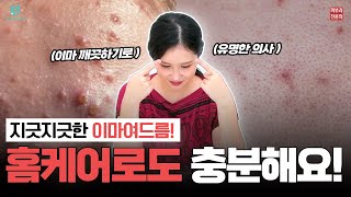 이마 여드름❗ 홈케어가 8할 병원은 2할 이렇게만 하면 해결 가능😘 [upl. by Badr]