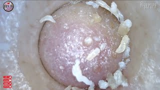 Rain  Blackhead Removal  brpvph pimple acne blackheads [upl. by Brogle]