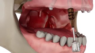 Straumann Pro Arch Step by Step Overview [upl. by Pat]