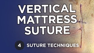 Vertical Mattress Suture  Learn Suture Techniques [upl. by Hilario]