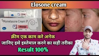 Eloson cream use benefits and Side effects full review in hindiMometasone01 [upl. by Anahsek691]