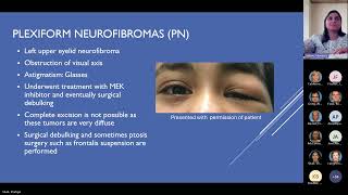 Pediatric Manifestations of Neurofibromatosis Type 1 Pediatric Grand Rounds Meeting 11 15 24 [upl. by Laural]