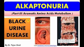 Alkaptonuria II Inborn error of aromatic amino acid metabolism II Biochemistry II Dr Tejas Shah [upl. by Imaj501]