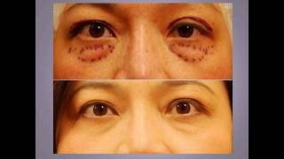 ChaseLayMD Ptosis Droopy Eyelid Surgery [upl. by Loseff]