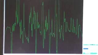 Myopathy EMG changes explained [upl. by Latham838]