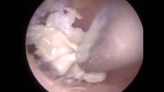 White Ear Wax Removed Revealing Infected Eardrum  Mr Neel Raithatha The Hear Clinic [upl. by Yngiram259]