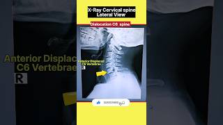 Cervical Spine Dislocation shorts xray [upl. by Pelmas]