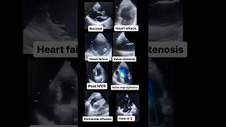 Echocardiogram NORMAL vs ABNORMAL radiology cardiology [upl. by Anehs]