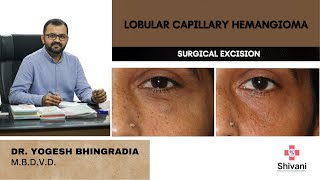 LOBULAR CAPILLARY HAEMANGIOMA  SURGICAL EXCISION  DR YOGESH BHINGRADIA [upl. by Homerus410]