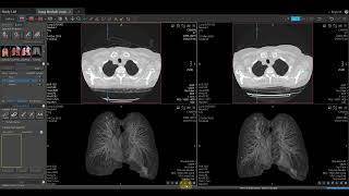 Vitrea Demonstrations  Lung Nodule Analaysis [upl. by Aikemaj]