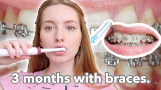 BRACES  3 month update  dental routine [upl. by Dru]