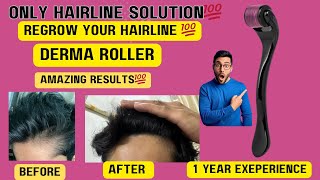 DERMA ROLLER results  best results after 1 year use [upl. by Macomber]