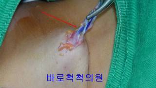 새열낭 branchial cleft cyst 鰓裂囊  전이개낭종preauricular sinus 수술하기 [upl. by Atilef]