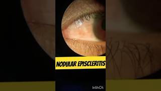 Nodular Episcleritis nodularepiscleritis eyediseases [upl. by Akeber940]