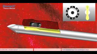 STEREOTACTIC VACUUM BIOPSY VAB [upl. by Darell307]