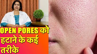 ओपन पोर्स को हटाने के कई तरीके  How To Get Rid of Large Open Pores Permanent Treatments [upl. by Ewell]