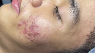 ACNE TREATMENT VU QUYNH MI  Perennial Blackheads On Boy Face 2024FULL [upl. by Akimyt]