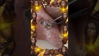 Blackheads Removal  Acne Treatment and Very Satisfying Satisfying Pimple pop blackheads [upl. by Ahsita]