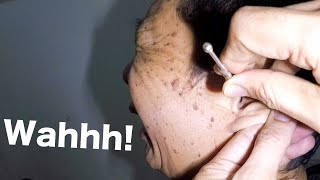 Removing Something STUCK amp TRAPPED in Mans Ear [upl. by Ennagrom]