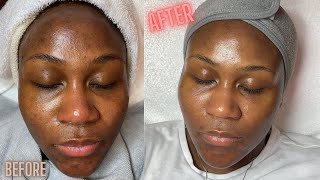 Hyperpigmentation Correction w Microdermabrasion [upl. by Anitsrihc]