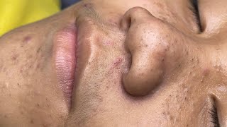 ACNE TREATMENT VU QUYNH MI  Blackheads Chin amp Nose Of Tweens 2024 EX [upl. by Anitnelav]