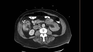 Ascending Colon Cancer [upl. by Hallett]