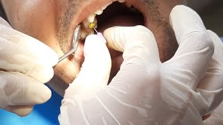 Root canal therapy RCT of upper right 1st premolar Root canal preparation all procedures [upl. by Dlopoel938]