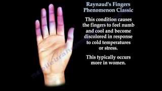 Raynauds Fingers Phenomenon classic  Everything You Need To Know  Dr Nabil Ebraheim [upl. by Haroun]