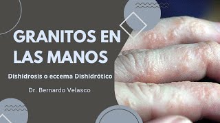 GRANITOS EN LAS MANOS PRURITO Vejiguitas en los dedos DISHIDROSIS O ECCEMA DISHIDRÓTICO 🖐 [upl. by Domela292]