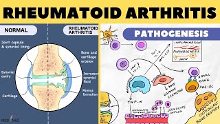 Rheumatoid Arthritis Pathophysiology  Rheumatoid Arthritis Pathogenesis  Arthritis pathophysiology [upl. by Docile]