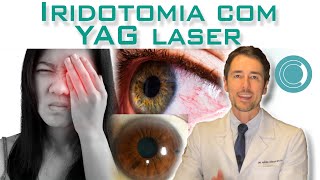 Iridotomia com YAG laser [upl. by Adnoek458]