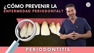 ¿Cómo prevenir la PERIODONTITIS o enfermedad de las encías [upl. by Sirama736]