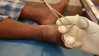 Myiasis Case  Maggots infestation [upl. by Yniatirb]