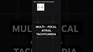 multifocal atrial tachycardia  ECG basics [upl. by Aubreir135]