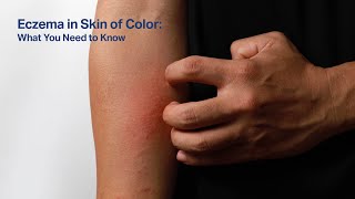 Eczema in skin of color What you need to know [upl. by Elia]