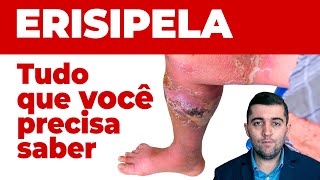 Erispela como curar sinais e sintomas e como prevenir suas complicações Guia completo da doença [upl. by Ylagam601]