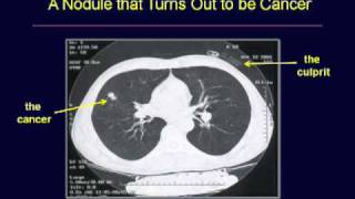 GRACEcast041LungCancerScreening Workup amp FollowUp [upl. by Berget]