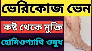 ভেরিকোস ভেইন হোমিও চিকিৎসা  Varicose Vein Homeopathic Treatment [upl. by Jena]