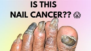 IS THIS NAIL CANCER symptoms  HOW TO IDENTIFY NAIL CANCER  SUBUNGUAL MELANOMA  MELANOMA [upl. by Ehcar236]