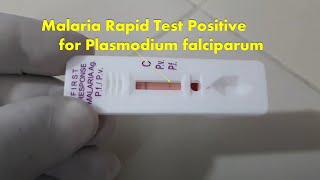 Malaria Rapid Test Positive Demonstration [upl. by Gautious]