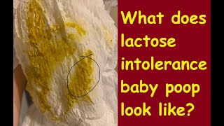 What does lactose intolerance baby poop look like [upl. by Grassi850]