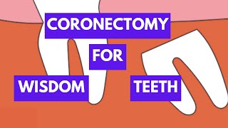 Coronectomy  Alternative Method to Remove Impacted Mandibular Third Molars [upl. by Airitac]