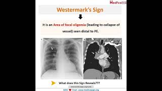 westermarks Sign Doctors Lifeplanetearth⚕️DAMS prepladder marrow neet medicoapps [upl. by Patsy423]