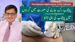 Percutaneous Nephrostomy PCN  گردوں میں پیشاب کی نالی ڈالنا [upl. by Katherine]