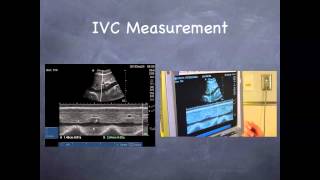 Tutorial Aorta amp IVC [upl. by Dachia]